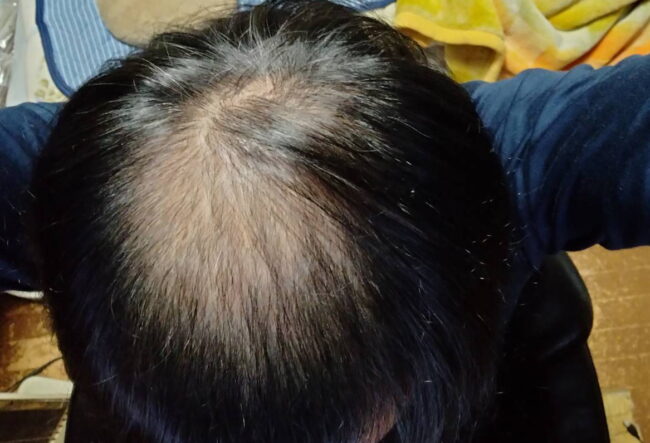 ヨコ美クリニックで頭頂部を1800株を植毛手術（FUT）しました。経過報告！